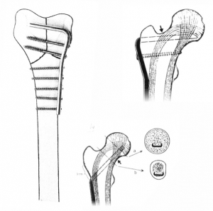 Angle Blade Plate for Proximal Femur Fracture